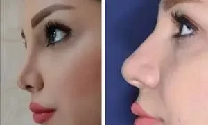 جراح بینی گوشتی در مشهد