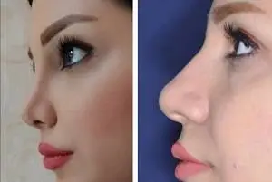 جراح بینی گوشتی در مشهد